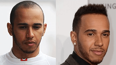 14 Celebrity Hair Transplants Before & After - Vera Clinic