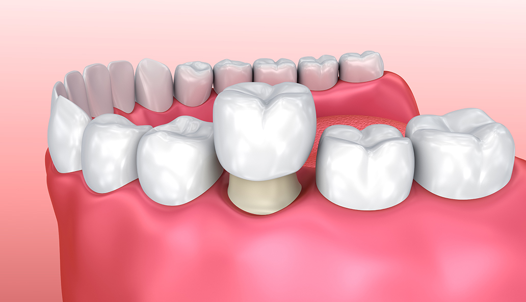 Dental Crowns Cost, Materials, Procedure, & FAQ
