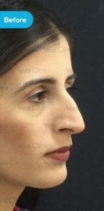 How To Make Your Nose Smaller Naturally In 4 Ways - Vera Clinic