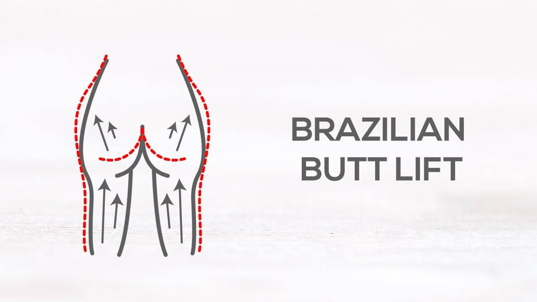 Brazilian Buttock Lift Las Vegas Cost Brazilian Butt Lift Cost, Warnings, and Results - Vera Clinic