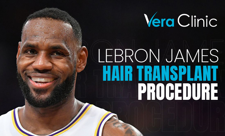 LeBron James Hair Transplant
