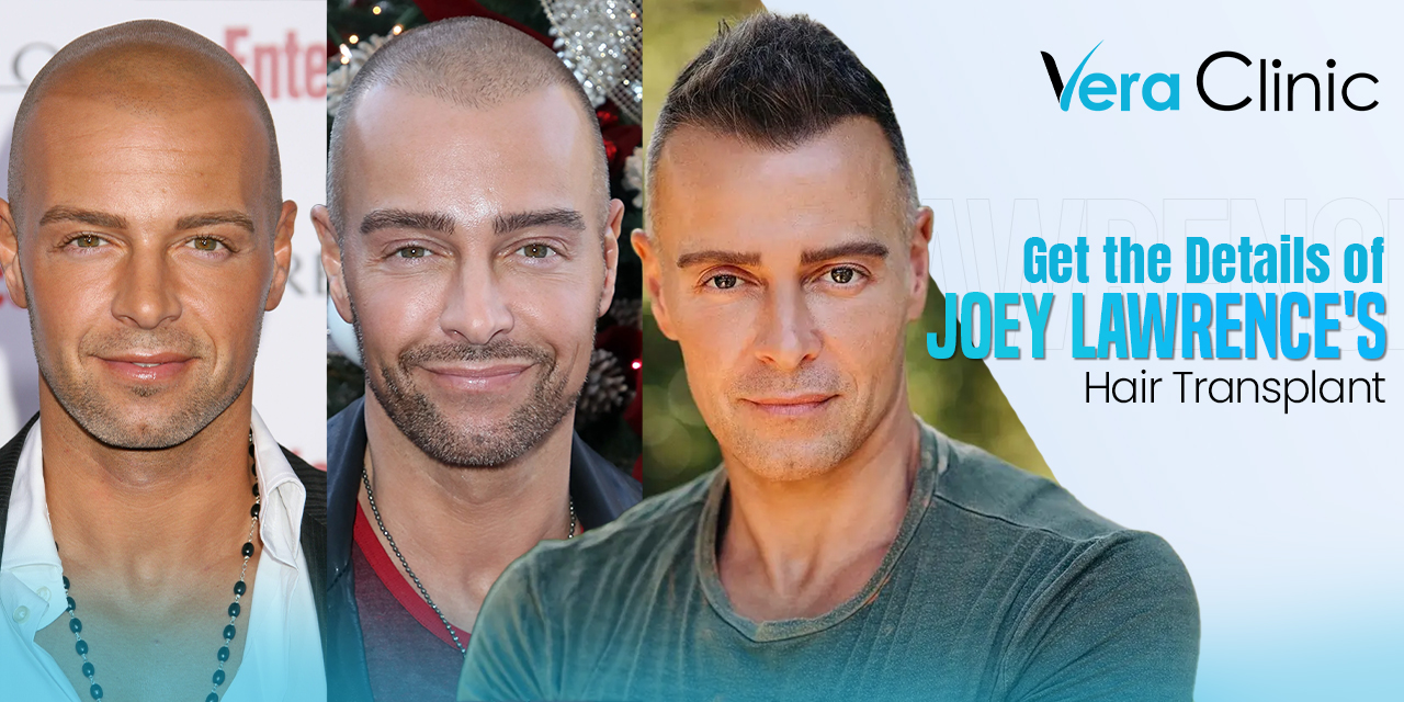 Get the Details of Joey Lawrence's Hair Transplant Vera Clinic