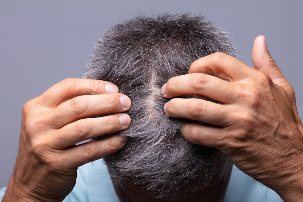 Man suffering from side effects of hair loss treatment. Dry Skin on scalp - how to get rid of dandruff