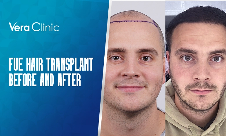 Fue Hair Transplant Before and After