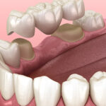 Los Puentes Dentales, ¿Son Mejores Que Un Implante?