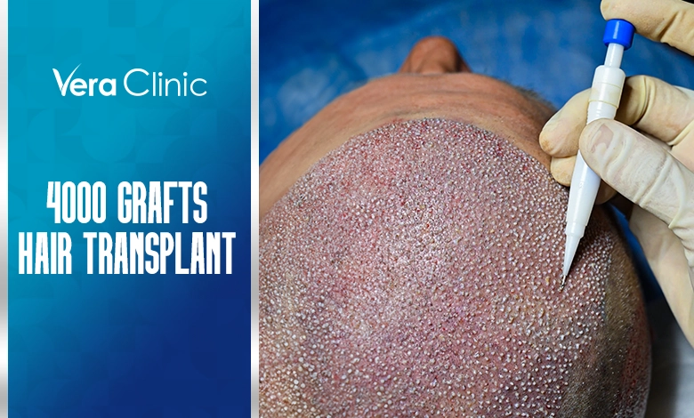 4000 Grafts Hair Transplant