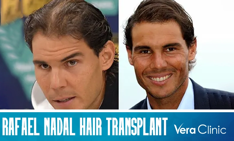 Rafael Nadals Hair Transplant