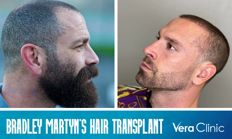 Bradley Martyn Hair Transplant