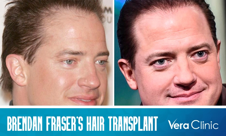 Brendan Fraser Hair Transplant