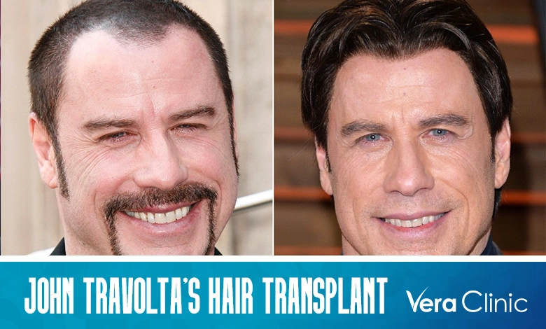 John Travolta's Hair Transplant