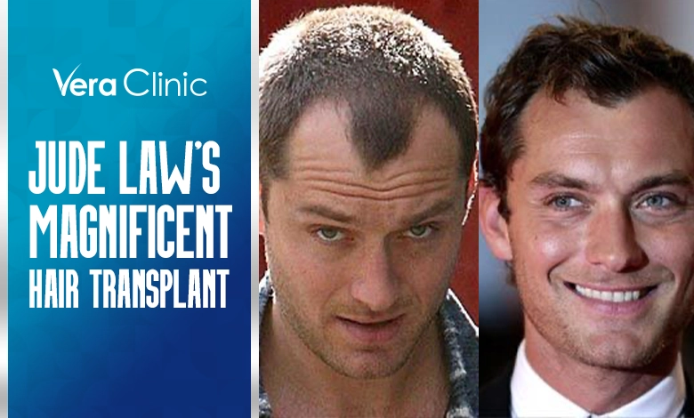 Jude Law's Magnificent Hair Transplantation