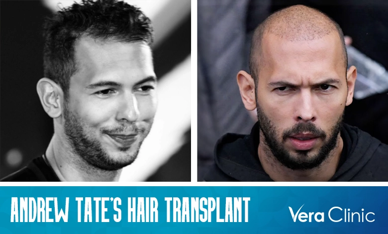 Andrew Tate Hair Transplant