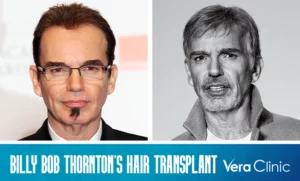 Billy Bob Thornton Hair Transplant