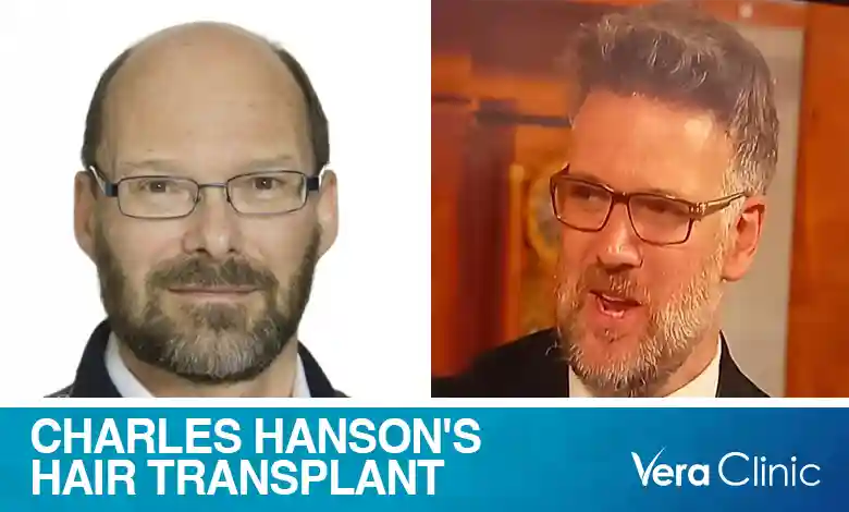 Charles Hanson Hair Transplant