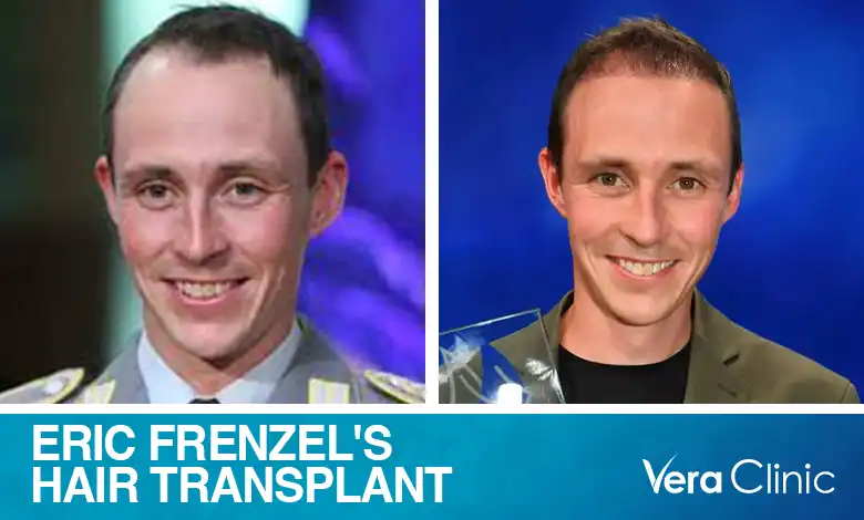 Eric Frenzel Hair Transplant