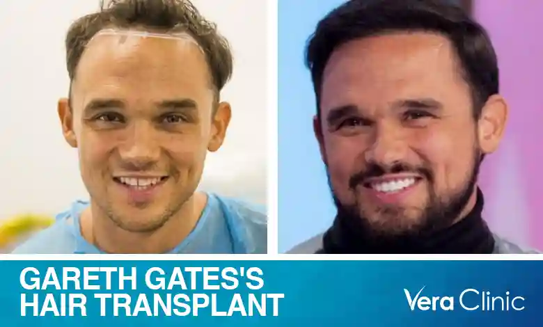 Gareth Gates Hair Transplant