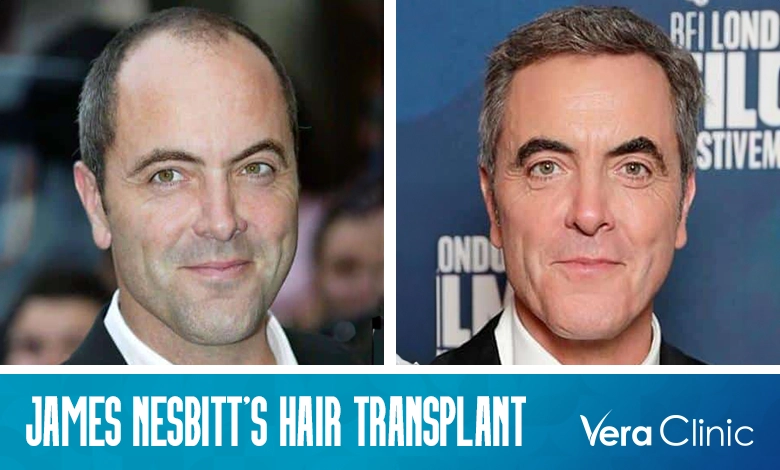 James Nesbitt Hair Transplant