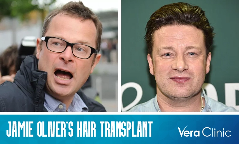 Jamie Oliver Hair Transplant