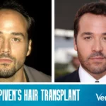 Jeremy Piven Hair Transplant