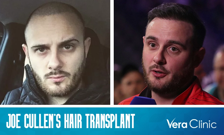 Joe Cullen Hair Transplant