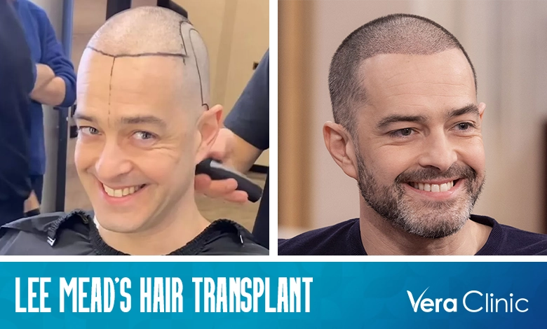 Lee Mead Hair Transplant