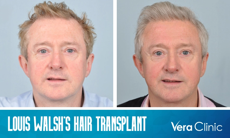 Louis Walsh Hair Transplant