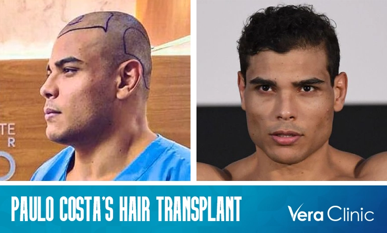Paulo Costa Hair Transplant