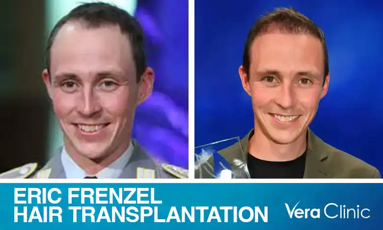 Eric Frenzel Haartransplantations