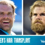 Greg Olsen Hair Transplant