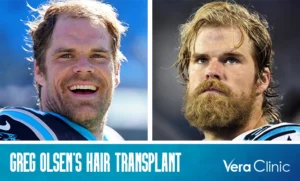 Greg Olsen Hair Transplant