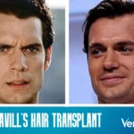Henry Cavill Hair Transplant