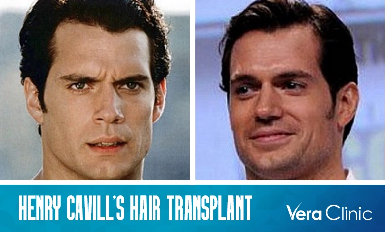 Henry Cavill Hair Transplant