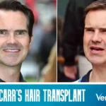 Jimmy Carr Hair Transplant