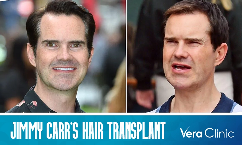Jimmy Carr Hair Transplant