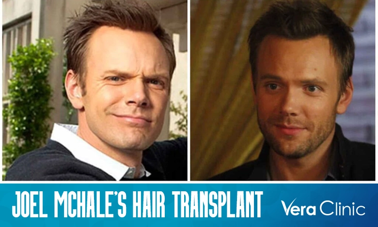 Joel McHale Hair Transplant