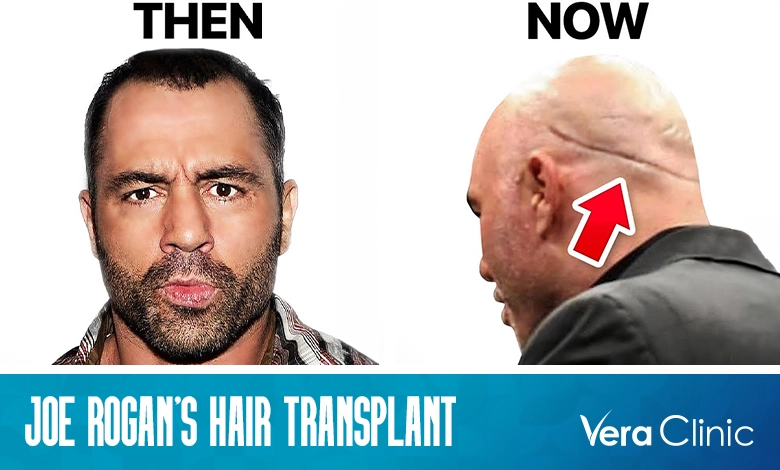 Joe Rogan Hair Transplant