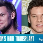 Theo Von Hair Transplant