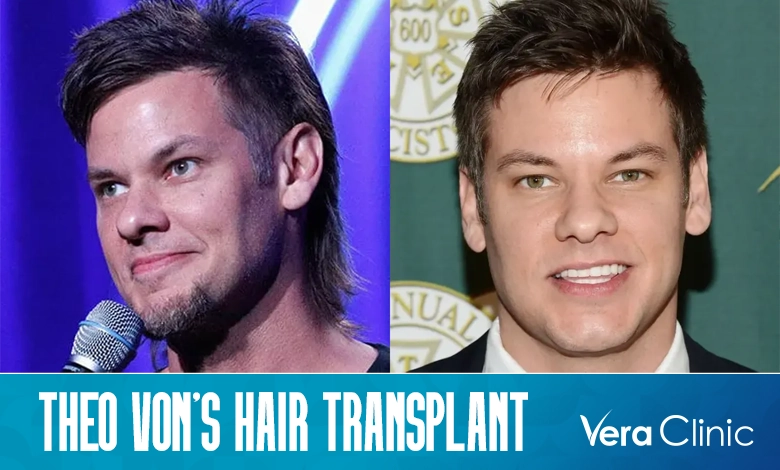 Theo Von Hair Transplant