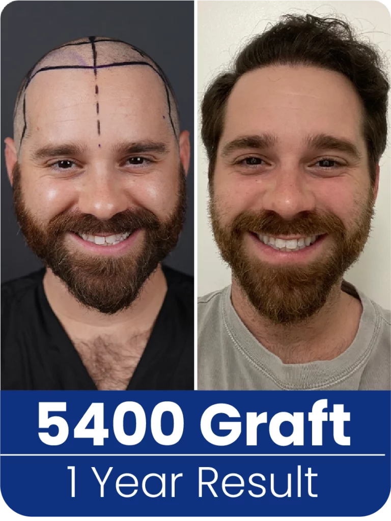 5400 Grafts Results Before After
