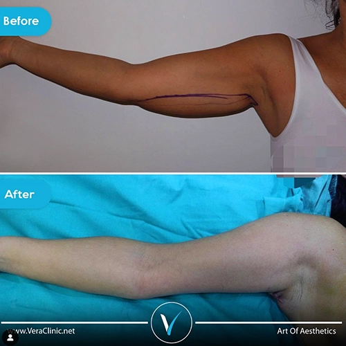 Arm Lift Before and After2