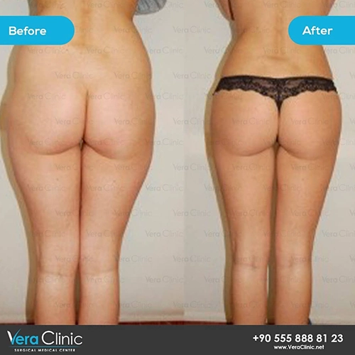 Brazilian Butt Lift Before and After3