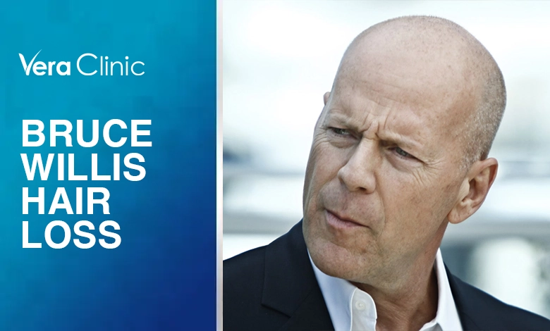 Bruce Willis Hair Loss