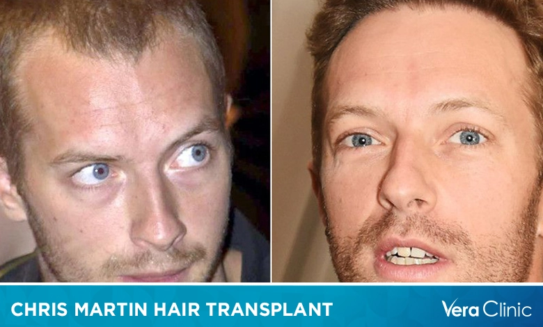 Chris Martin Hair Transplant