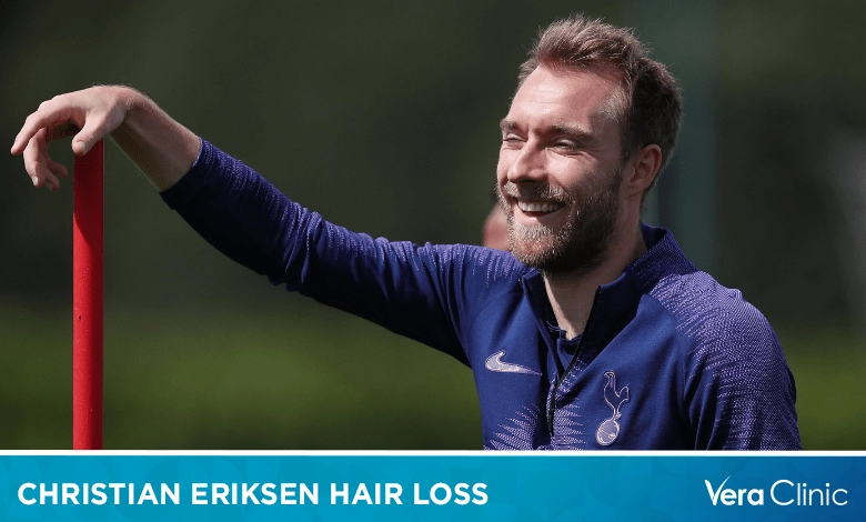 Christian Eriksen Hair Loss