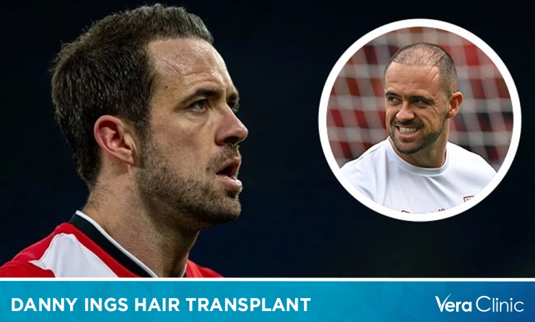 Danny Ings Hair Transplant