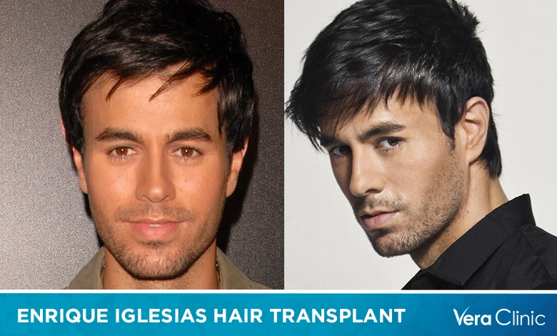 Enrique Iglesias Hair Transplant