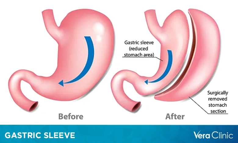 Gastric sleeve cost