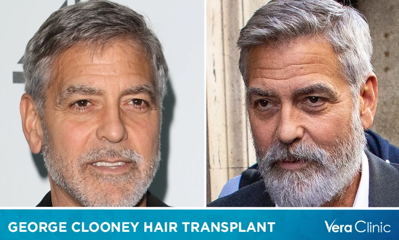 George Clooney Hair Transplant
