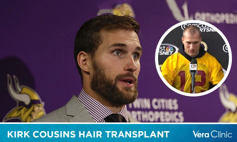 Kirk Cousins Hair Transplant