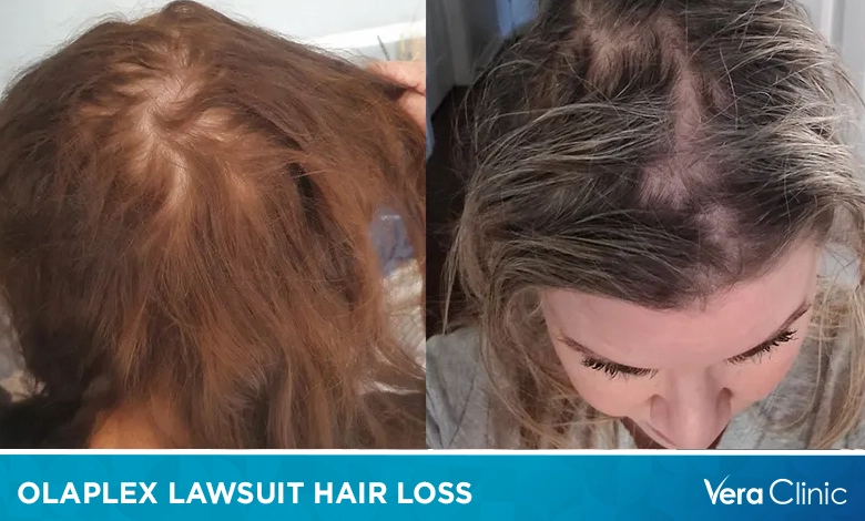 Olaplex Lawsuit Hair Loss